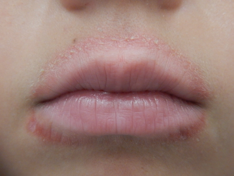 Periorale Dermatitis: Erythem und feine Schuppung perioral bei einem Kind mit Lippenlecker-Gewohnheit