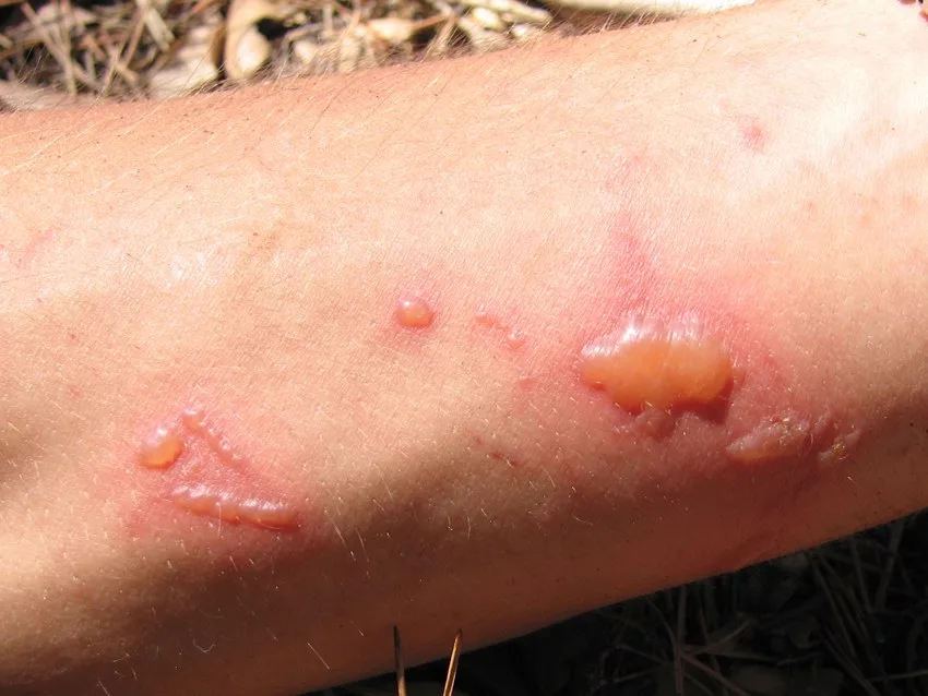 Wiesengrasdermatitis – klinisches Foto: streifig angeordnete, gespannte Blasen auf geröteter Haut am Unterarm nach Kontakt mit Weinraute und Sonne