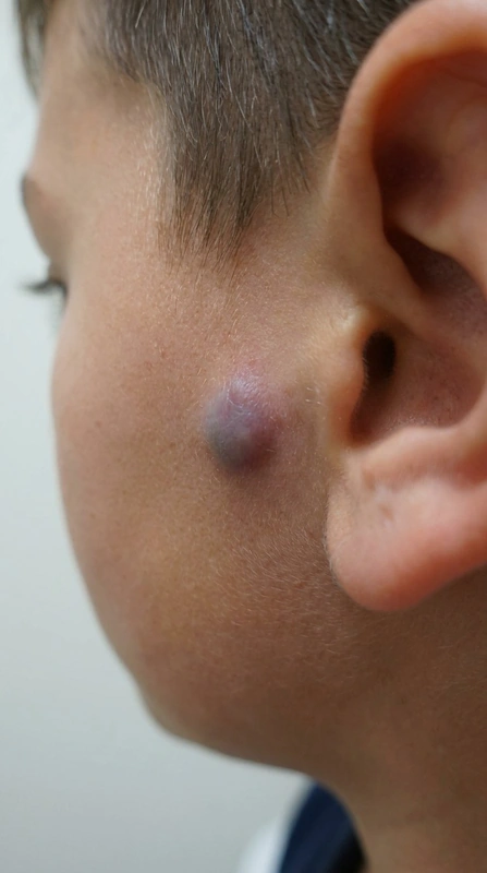Pilomatricoma (calcifying epithelioma of Malherbe) – AI illustration (not a patient photo): hard stone-like subcutaneous nodule with bluish-reddish shimmering overlying skin preauricular in a child (10-year-old child, preauricular)