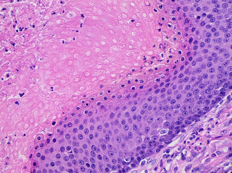 Pilomatricoma (calcifying epithelioma of Malherbe) – histology (H&E), detail: basaloid cells, ghost cells with empty nuclear spaces and a zone of necrosis