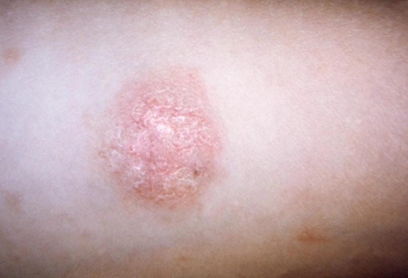 Pityriasis rosea: Primärmedaillon: ovale, randständig schuppende Plaque (Collerette).