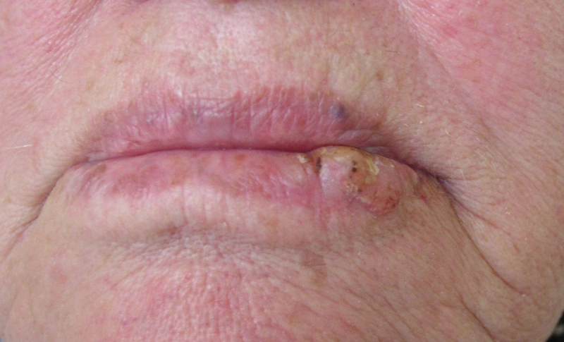 Plattenepithelkarzinom der Haut (cSCC): derber, gelblich verkrusteter Knoten am Lippenrot einer 83-jährigen Frau, angrenzend unscharf begrenztes, atrophes Lippenrot im Sinne einer aktinischen Cheilitis (Foto: Klaus D. Peter)