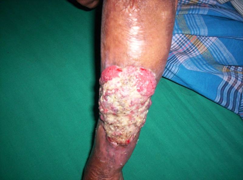 Plattenepithelkarzinom der Haut (cSCC): exophytisch blumenkohlartig wuchernder, nekrotisch-fibrinös belegter Tumor mit hochrotem, leicht blutendem Randsaum, zirkulär eine Extremität umfassend (Foto: Raj d0509) (Foto: Raj d0509), Wikimedia Commons, Public Domain)