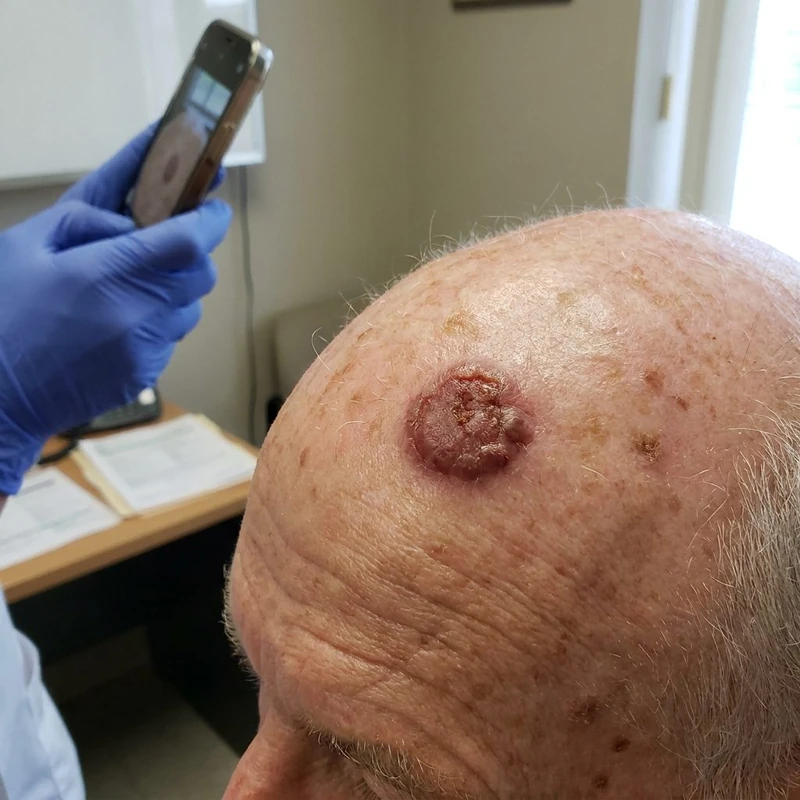 Pleomorphic dermal sarcoma: reddish-brown, irregularly defined, elevated lesion on the scalp.