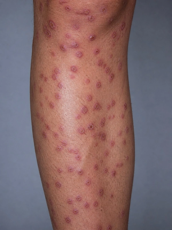 PLEVA (Pityriasis lichenoides et varioliformis acuta): akut auftretende papulonekrotische Läsionen (Mann, Unterschenkel)