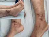 Polyarteriitis nodosa