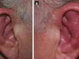 Polychondritis recidivans