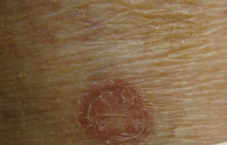 Porokeratose: scharf begrenzte, ringförmige Plaque mit hornartigem, girlandenförmigem Randsaum (cornoid lamella) und leicht atrophem Zentrum am Unterschenkel