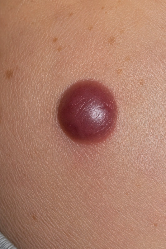 Primär kutanes anaplastisches großzelliges Lymphom (pcALCL) – KI-Illustration (kein Patientenfoto): solitärer, rasch wachsender, livid-roter, derb infiltrierter Knoten mit zentraler Ulzeration