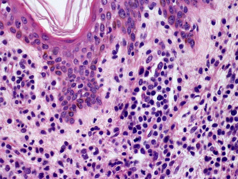 Primär kutanes anaplastisches großzelliges Lymphom (pcALCL) – Histologie (HE): dichtes, diffuses dermales Infiltrat bis unmittelbar an die Epidermis, mit großen pleomorphen Zellen, teils nierenförmigen Kernen, prominenten Nukleolen und beigemengten …