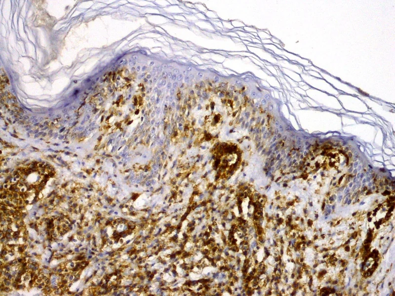 Primär kutanes anaplastisches großzelliges Lymphom (pcALCL) – Histologie: Immunhistochemie (CD30 laut Quelle, im Bild nicht beschriftet): flächig braun markiertes dermales Infiltrat großer Zellen, einzelne kräftig positive große Zellen intraepidermal, negative …