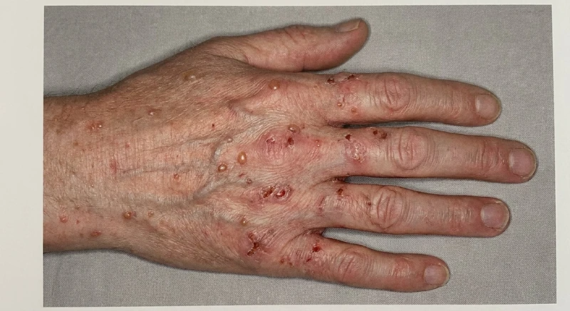 Pseudo-Porphyria cutanea tarda: fragile Haut mit prallen Bullae, Erosionen und milienartigen Narben an Hand- und Fingerrücken