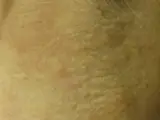 Pseudoxanthoma elasticum (PXE, Grönblad-Strandberg)