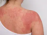 Psoriasis pustulosa generalisata (Typ Zumbusch)