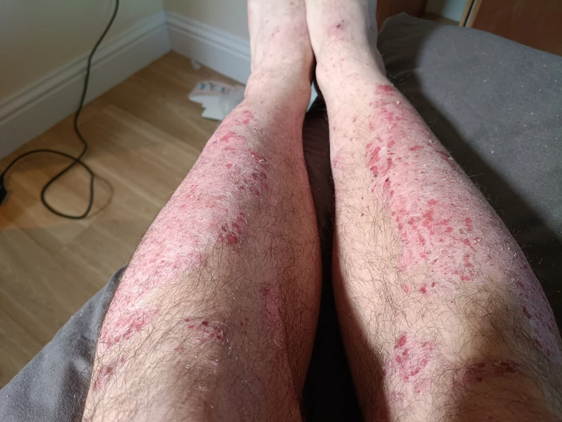 Psoriasis vulgaris (Schuppenflechte): multiple erythematosquamöse Plaques an beiden Unterschenkeln