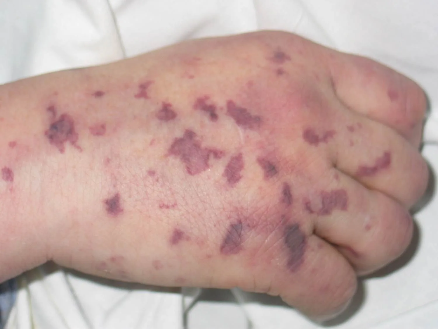Purpura fulminans – klinisches Foto: sternförmige, eckig verzweigte hämorrhagische Flecken am Handrücken (Hautbild der beginnenden akut-infektiösen Purpura fulminans)