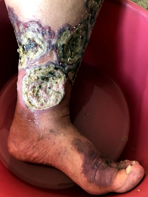 Pyoderma gangraenosum: ausgedehnte nekrotische Ulzera mit unterminiertem, livid-violettem Randsaum am Unterschenkel (57-jähriger Patient, septischer Verlauf)
