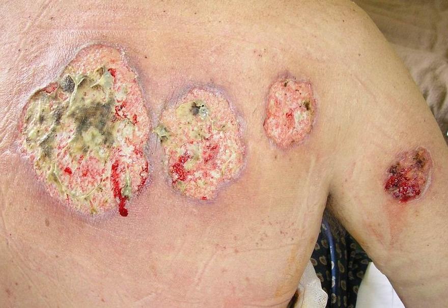 Pyoderma gangraenosum: mehrere münz- bis handtellergroße Ulzera mit violettem, unterminiertem Randsaum an der Schulter