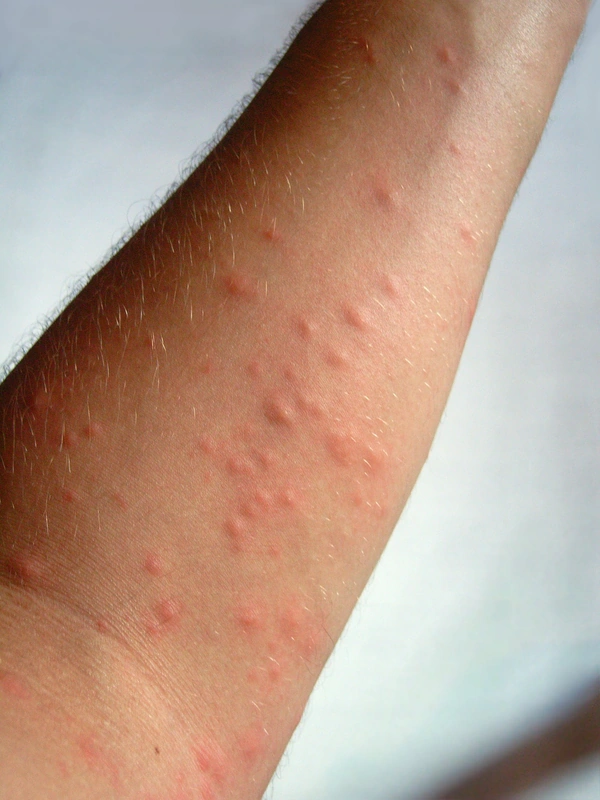 Raupendermatitis durch Eichenprozessionsspinner (Thaumetopoea processionea): multiple juckende, urtikarielle Papeln am Unterarm.