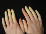 Raynaud-Syndrom – klinisches Foto