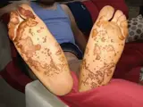 Reiter-Syndrom (reaktive Arthritis)