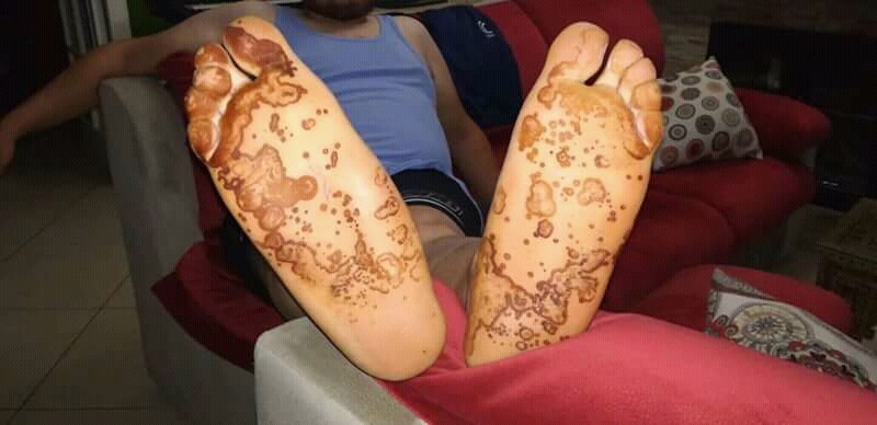 Reiter-Syndrom (reaktive Arthritis): Keratoderma blennorrhagicum mit psoriasiformen, hyperkeratotischen Herden auf beiden Fußsohlen