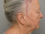 Riesenzellarteriitis (Arteriitis temporalis)