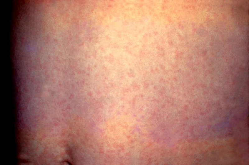 Röteln (Rubella) – klinisches Foto: feinfleckiges, blassrosa Exanthem mit Aussparungen