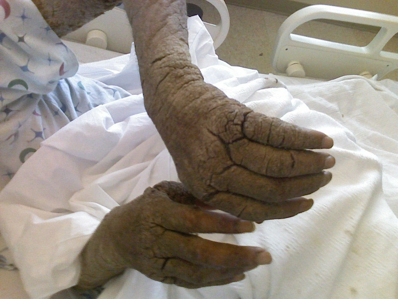 Crusted (Norwegian) scabies: massive hyperkeratotic, fissured crusts on both hands in an immunosuppressed (AIDS) patient (Foto: Ukster1 (English Wikipedia), Wikimedia Commons, Public Domain)