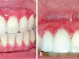 Schleimhautpemphigoid (vernarbendes Pemphigoid)