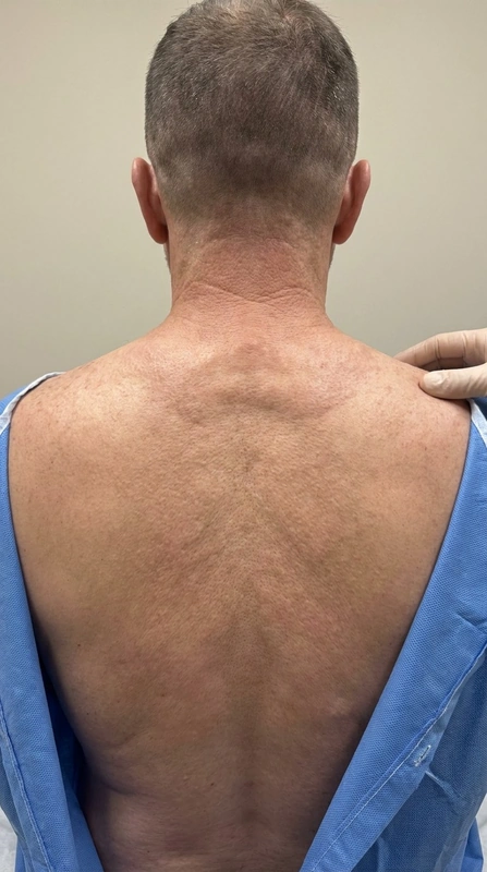 Scleroedema adultorum Buschke (Skleroedem) – KI-Illustration (kein Patientenfoto): symmetrische peau-d'orange-artige Verhärtung an Nacken/oberem Rücken/Schultern, 50-j. Mann