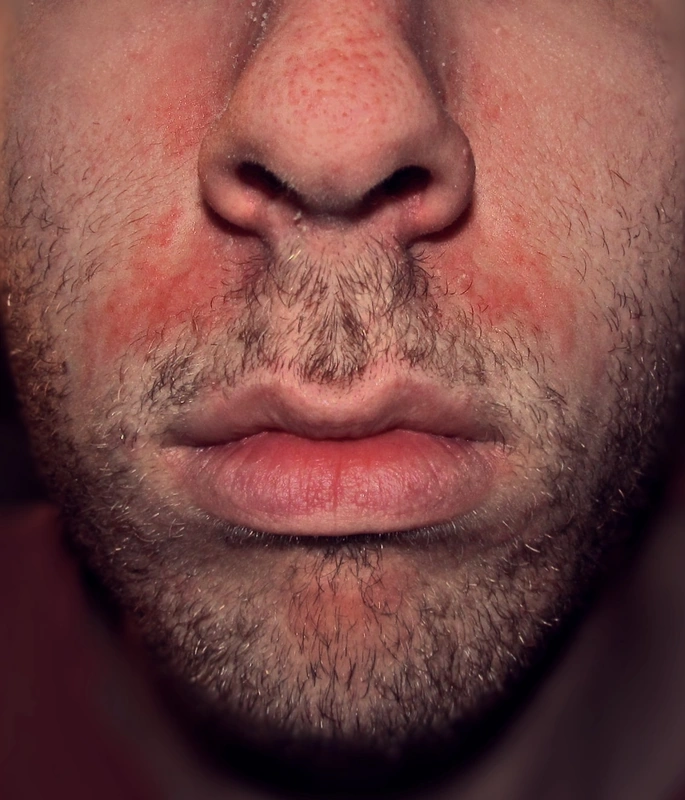 Seborrhoeic dermatitis: erythematous, scaly plaques along the nasolabial folds and chin, image cropped to the lower third of the face