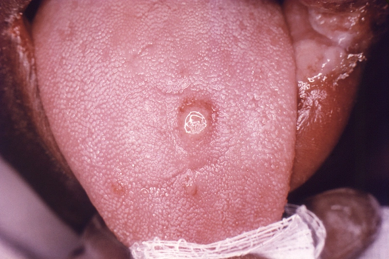 Sekundärsyphilis (Lues II): runder, scharf begrenzter Ulkus mit wallartigem Rand und glattem Grund auf dem Zungenrücken; oraler Primäraffekt nach orogenitalem Kontakt