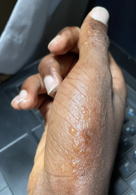 Scabies: papular and vesicular lesions in the finger web space, adult