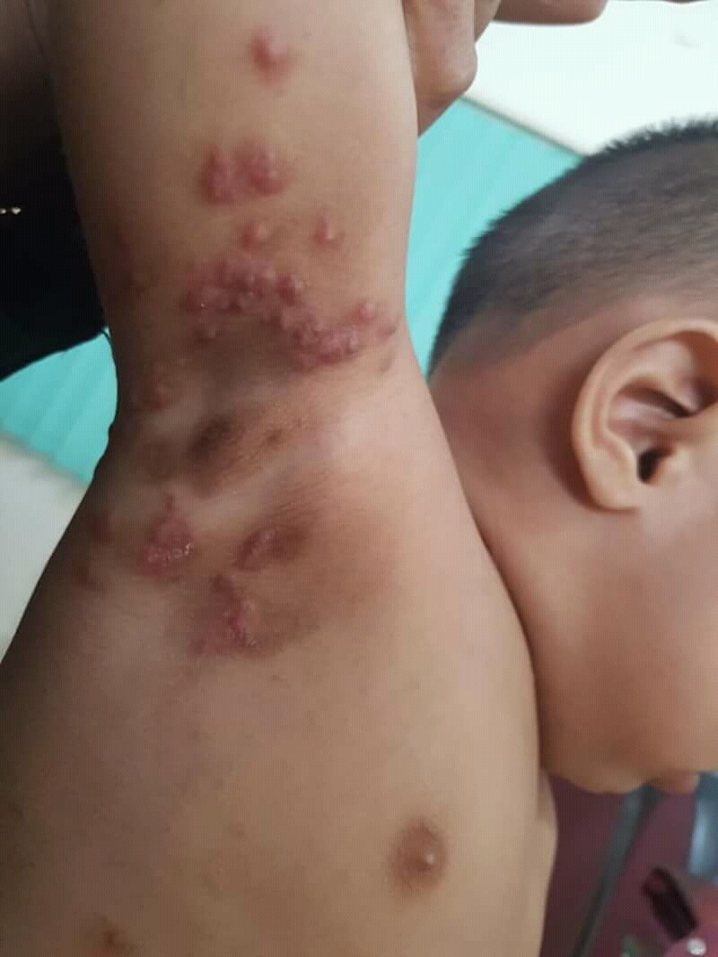 Scabies: Papeln und Papulovesikel in der Axilla und am seitlichen Rumpf.