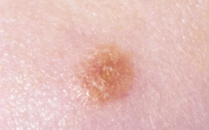 Spitz-Nävus (Spindel- und Epitheloidzellnävus) – klinisches Foto: kleine, symmetrische, gleichmäßig rosa-hellbraune Papel