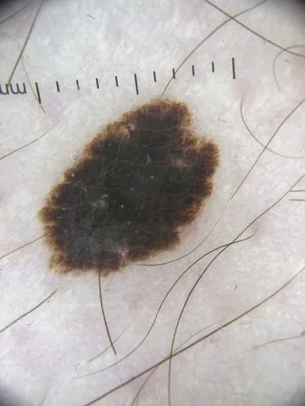 Spitz-Nävus (Spindel- und Epitheloidzellnävus) – dermatoskopisch: Starburst-Muster mit schwarzem Zentrum und geschlossenem Strahlenkranz