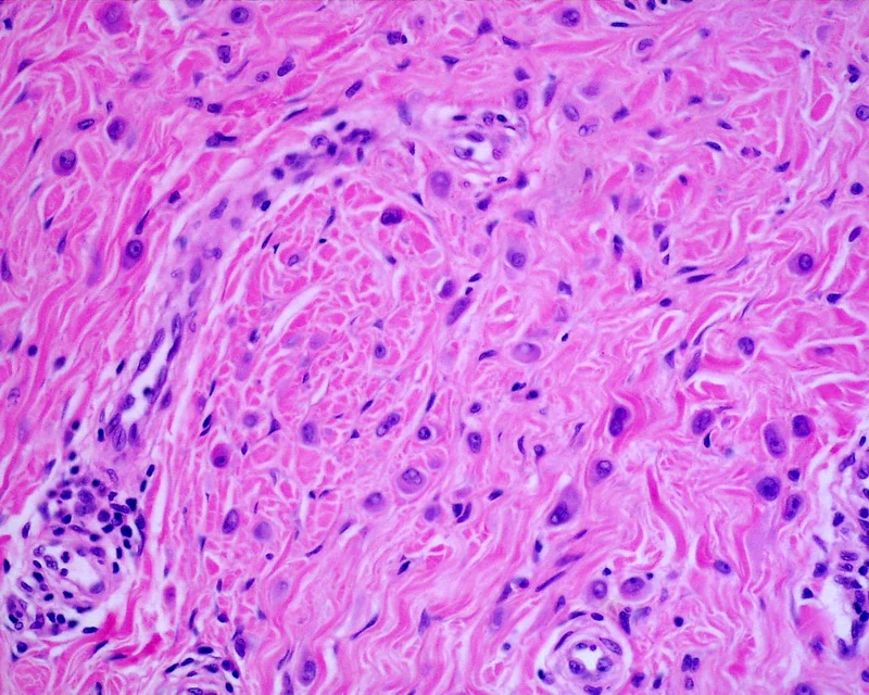 Spitz-Nävus (Spindel- und Epitheloidzellnävus) – Histologie (HE), Detailausschnitt: einzeln zwischen verdichteten, sklerosierten Kollagenbündeln liegende spindelige bis epitheloide Zellen – damit vereinbar; ohne Epidermis, …