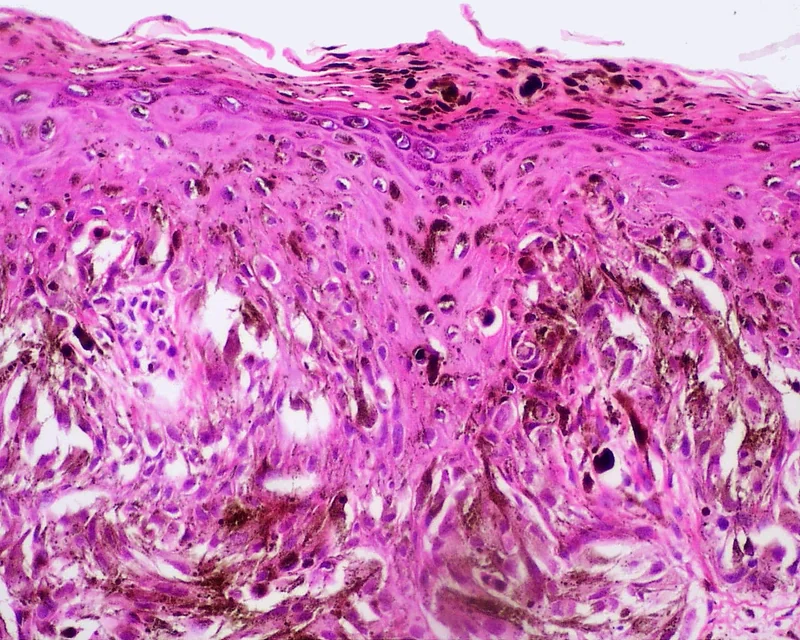 Spitz-Nävus (Spindel- und Epitheloidzellnävus) – Histologie (HE), stark überfärbter Ausschnitt: reichlich Melaninpigment in der oberen Dermis (Melanophagen) und pigmentierte Zellen bis in die oberen Epidermisschichten; einzelne Nester …