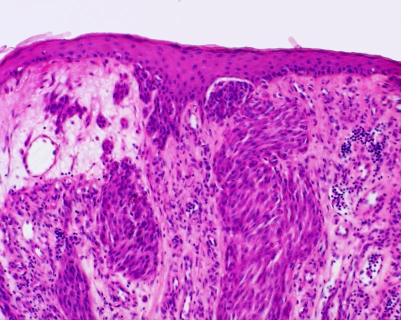Spitz-Nävus (Spindel- und Epitheloidzellnävus) – Histologie (HE): Nester großer spindeliger und epitheloider Melanozyten