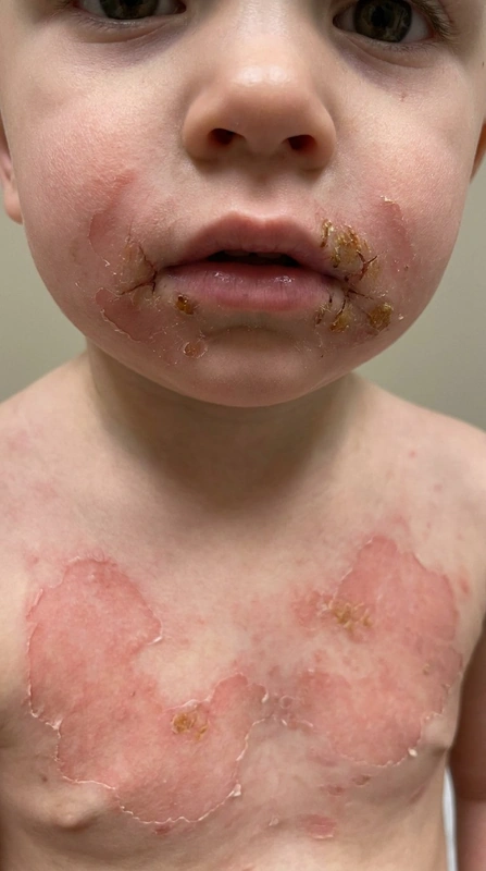 Staphylococcal scalded skin syndrome (SSSS, staphylogenes Lyell-Syndrom) – Baby – KI-Illustration (kein Patientenfoto): großflächige oberflächliche Hautablösung wie verbrüht periorale Krusten radiäre Rhagaden Säugling (2-jaehriges-kleinkind, gesicht und stamm)
