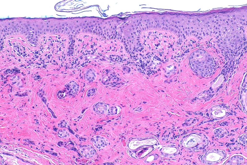 Syringom – Histologie (HE): zahlreiche kleine Duktus-Strukturen und solide Stränge in sklerotischem Stroma der oberen Dermis, unauffällige Epidermis
