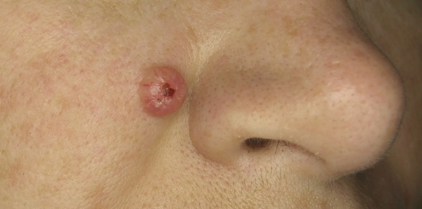 Trichoepitheliom – Gesicht – klinisches Foto: solitäre, kuppelförmige, rötlich-hautfarbene Papel mit kleiner zentraler Kruste an der Wange neben dem Nasenflügel