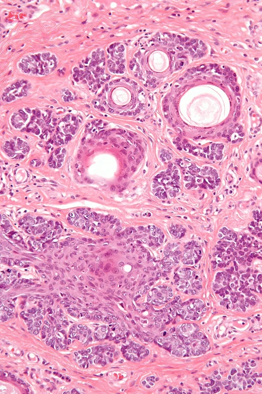 Trichoepitheliom – Histologie (HE): monomorphe basaloide Zellnester mit mehreren scharf begrenzten Hornzysten in fibrösem Stroma, ohne Retraktionsspalten zum Stroma; papilläre mesenchymale Körperchen sind …