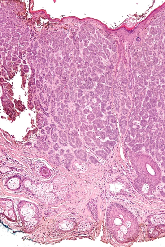 Trichoepitheliom – Histologie (HE), Übersicht: gut umschriebener dermaler basaloider Tumor unter intakter Epidermis, Lobuli mit peripherer Palisadenstellung und Retraktionsspalten zum Stroma, erhaltene …