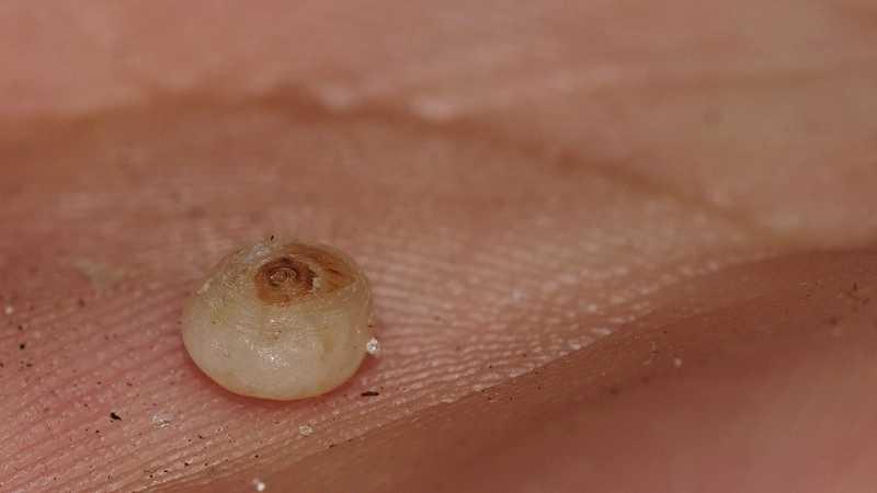 Tungiasis: weißliche, kugelige Papel mit zentralem schwarzem Punkt (Hinterleibsende des Sandflohs) an der Zehe