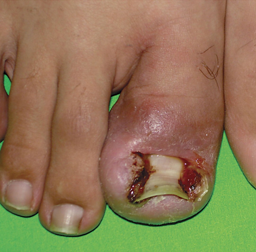 Ingrown toenail (unguis incarnatus): great toe with a markedly swollen, red lateral nail fold and exuberant granulation tissue overgrowing the nail plate (Photo: Flydochc, Wikimedia Commons, CC BY-SA 3.0)