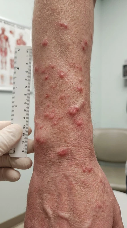 Papular urticaria – AI illustration (not a patient photo): Erythematous papules and occasionally plaques on the forearm