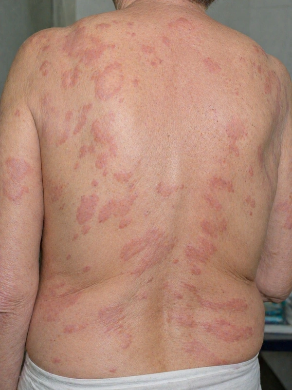 Urtikariavaskulitis (normo- und hypokomplementämisch) – KI-Illustration (kein Patientenfoto)