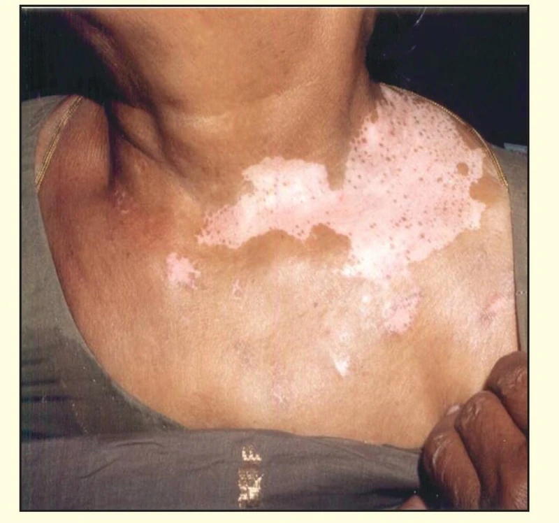 Vitiligo
